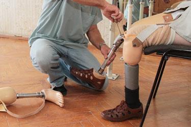 Mand får hjælp med benprotese
